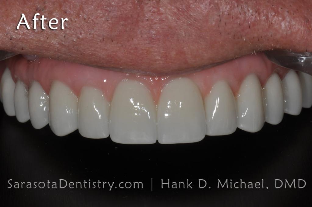 Full Arch Zirconia All on 6 Dental Implants Case — view 4