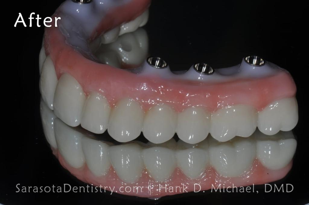 Full Arch Zirconia All on 6 Dental Implants Case — view 7
