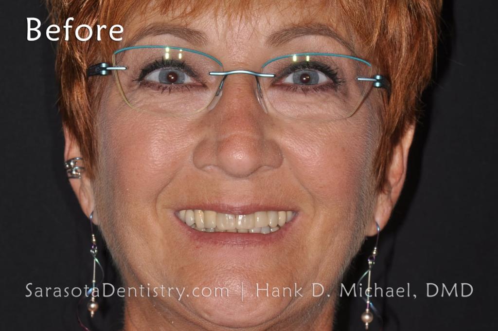 Amazing Porcelain to Zirconia Smile Makeover — view 2