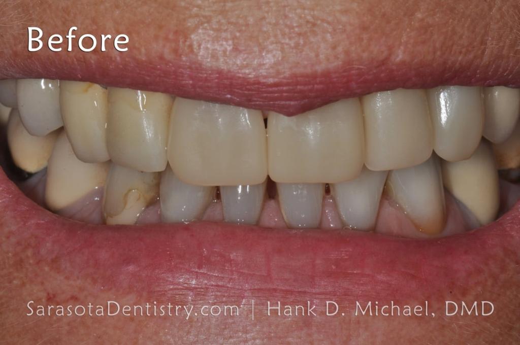 Amazing Porcelain to Zirconia Smile Makeover — view 3