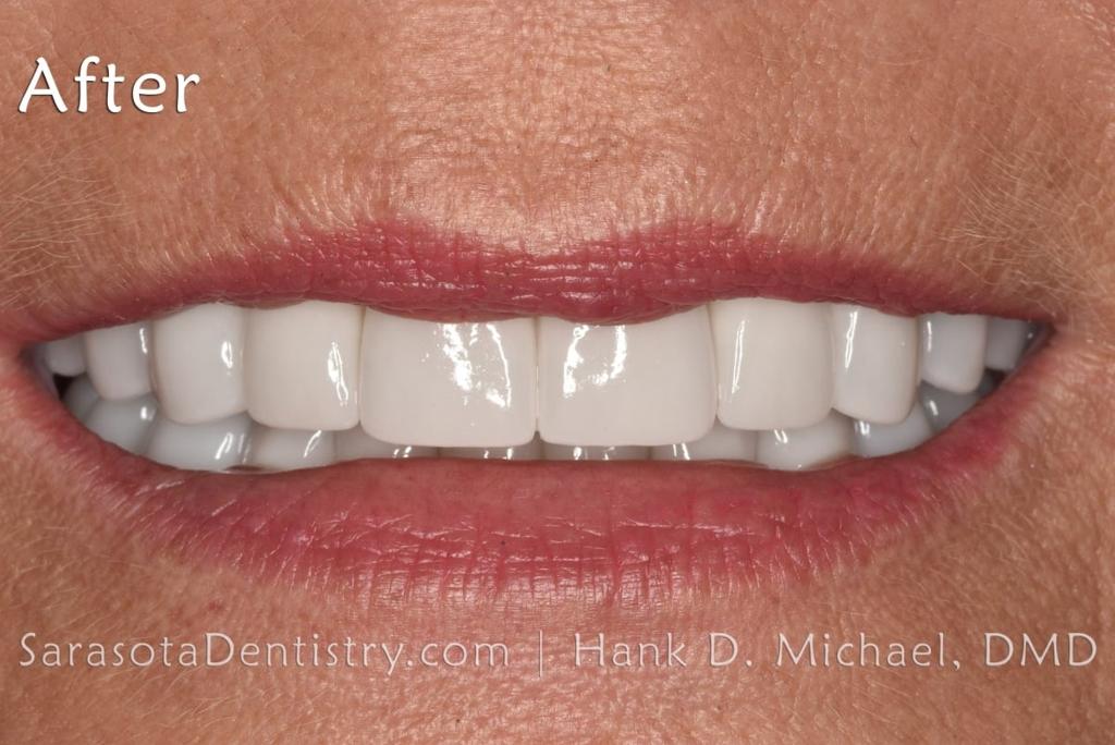 Amazing Porcelain to Zirconia Smile Makeover — view 4