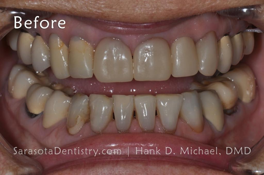 Amazing Porcelain to Zirconia Smile Makeover — view 5