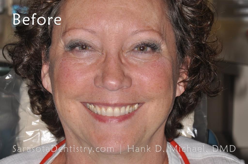 Porcelain to Zirconia Crowns Smile Makeover 18 — view 2
