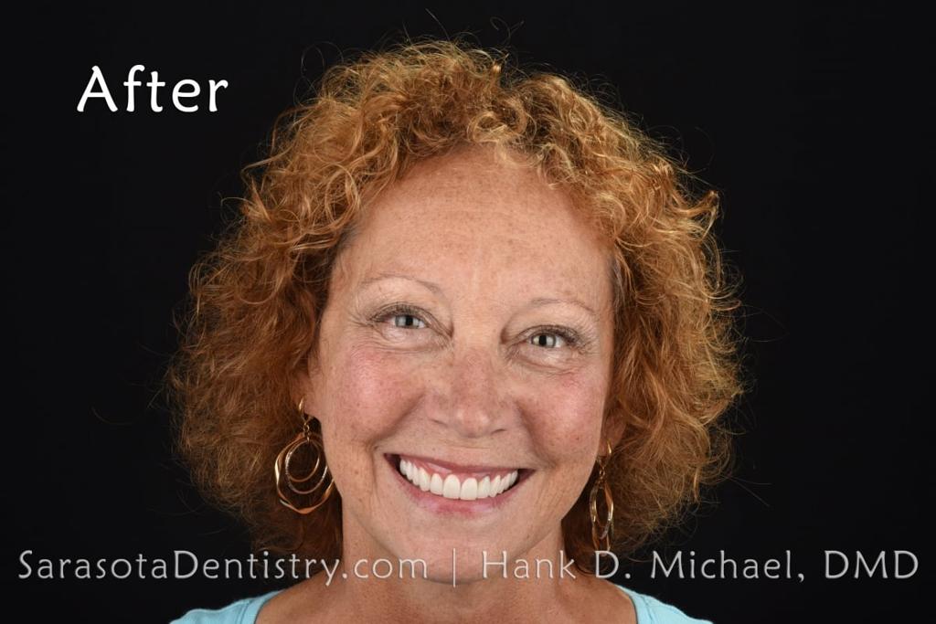 Porcelain to Zirconia Crowns Smile Makeover 18 — view 1