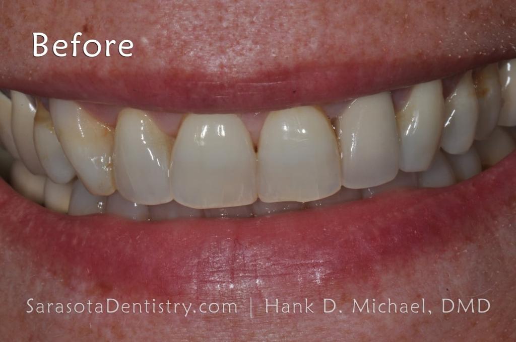 Porcelain to Zirconia Crowns Smile Makeover 18 — view 3