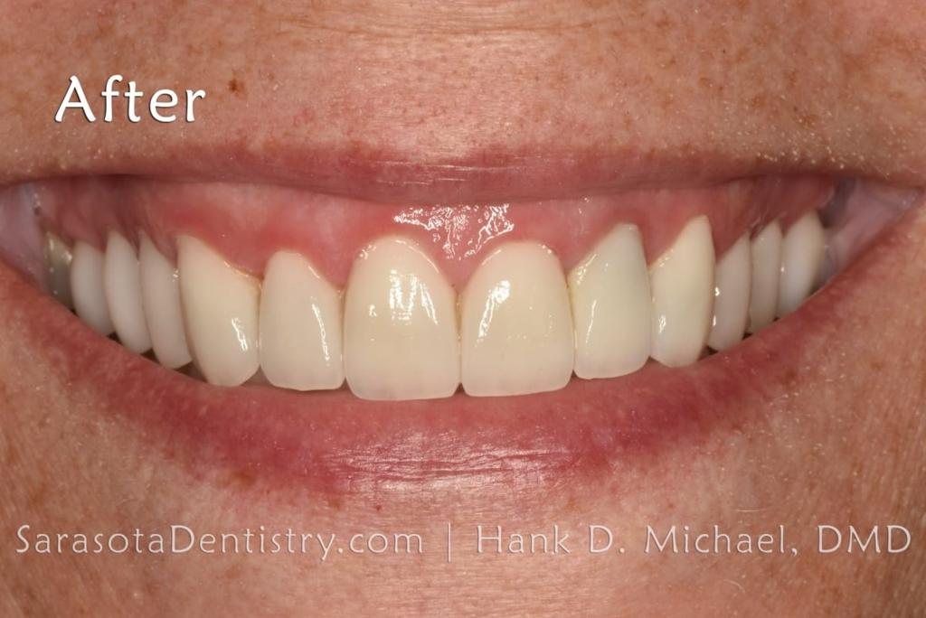 Porcelain to Zirconia Crowns Smile Makeover 18 — view 4