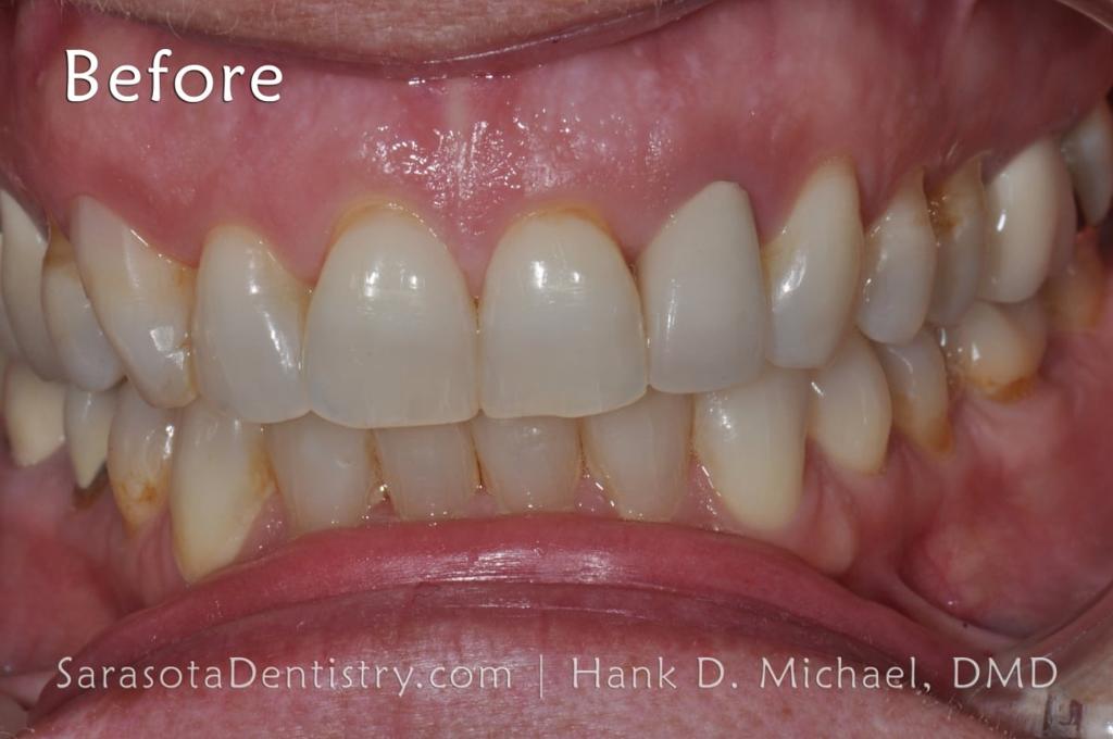 Porcelain to Zirconia Crowns Smile Makeover 18 — view 5