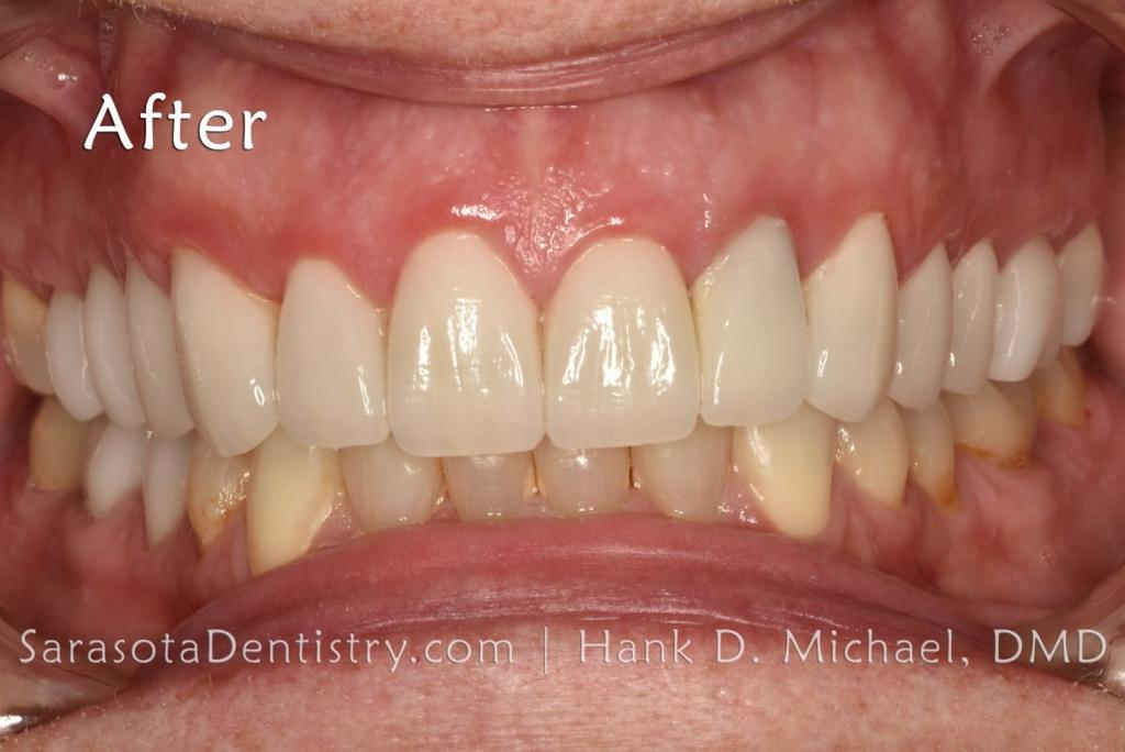 Porcelain to Zirconia Crowns Smile Makeover 18 — view 6