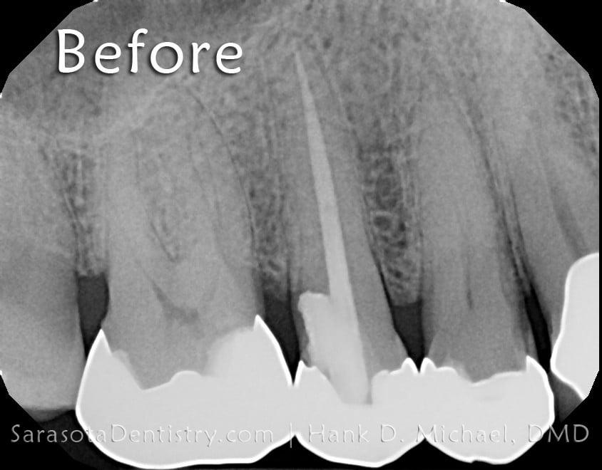 Dental Implants Case 7 | Immediate Dental Implant — view 1
