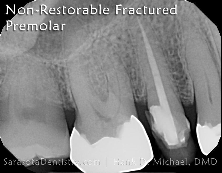 Dental Implants Case 7 | Immediate Dental Implant — view 3