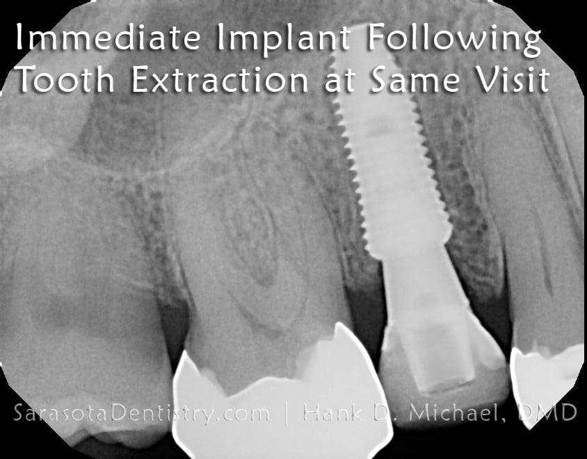 Dental Implants Case 7 | Immediate Dental Implant — view 2