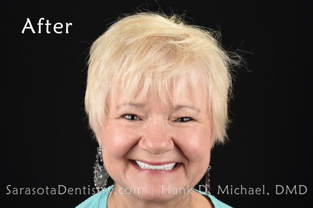 Porcelain to Zirconia Crowns Smile Makeover 20 — view 2