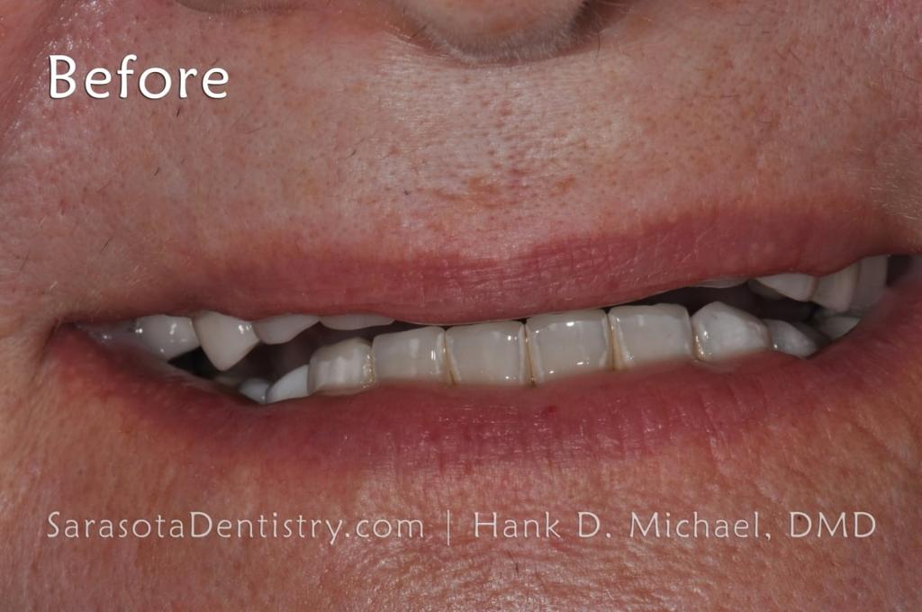 Porcelain to Zirconia Crowns Smile Makeover 20 — view 3
