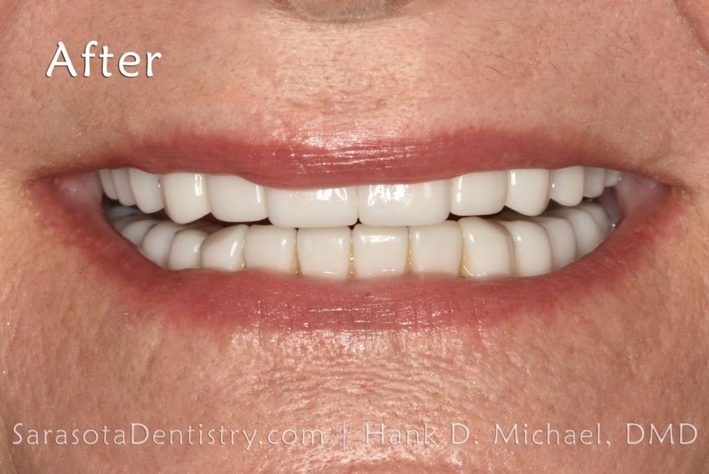 Porcelain to Zirconia Crowns Smile Makeover 20 — view 4