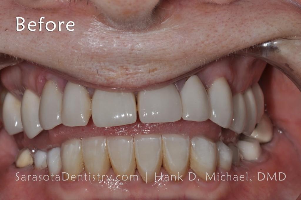Porcelain to Zirconia Crowns Smile Makeover 20 — view 5