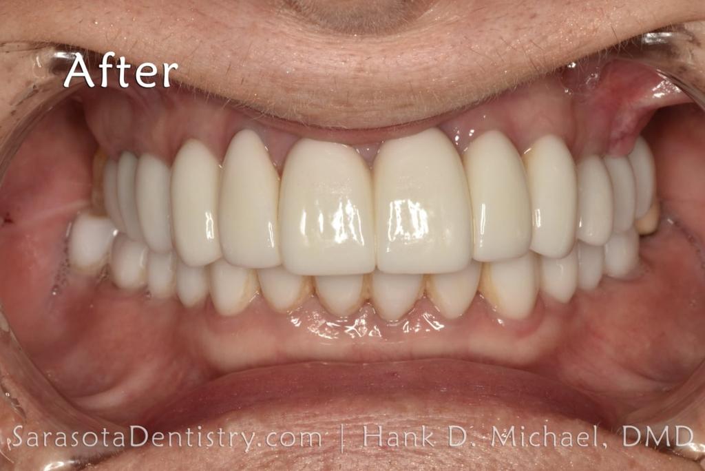 Porcelain to Zirconia Crowns Smile Makeover 20 — view 6