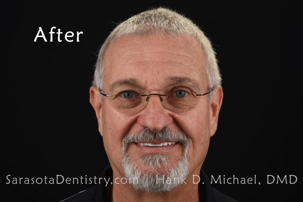 Porcelain to Zirconia Crowns Smile Makeover 18 — view 2