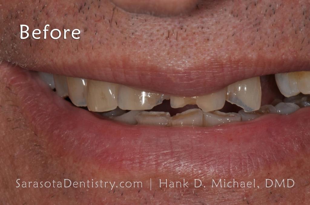 Porcelain to Zirconia Crowns Smile Makeover 18 — view 3