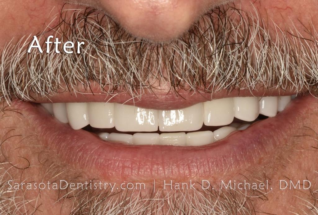 Porcelain to Zirconia Crowns Smile Makeover 18 — view 4