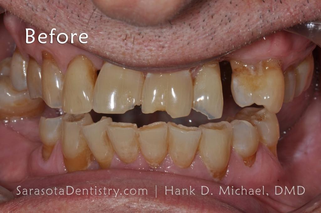 Porcelain to Zirconia Crowns Smile Makeover 18 — view 5