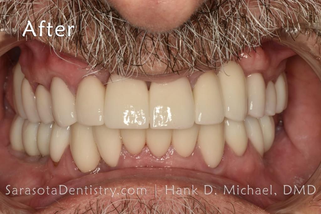 Porcelain to Zirconia Crowns Smile Makeover 18 — view 6