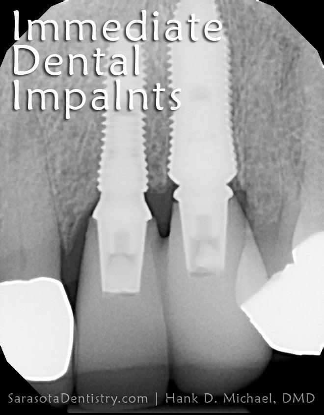 Dental Implant Case #5 — view 2