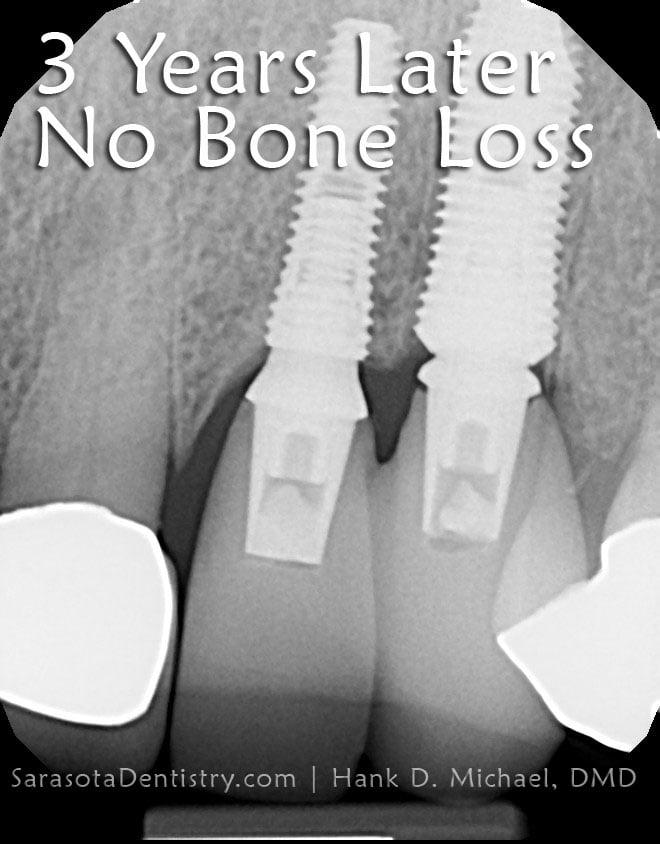 Dental Implant Case #5 — view 3