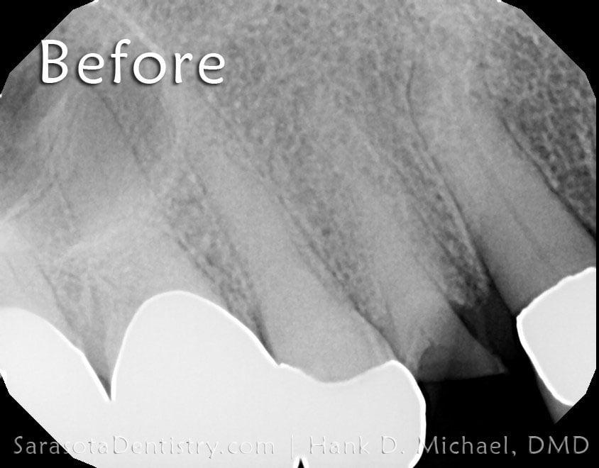 Broken Premolar Treated with Dental Implant — view 1