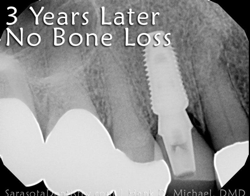 Broken Premolar Treated with Dental Implant — view 3