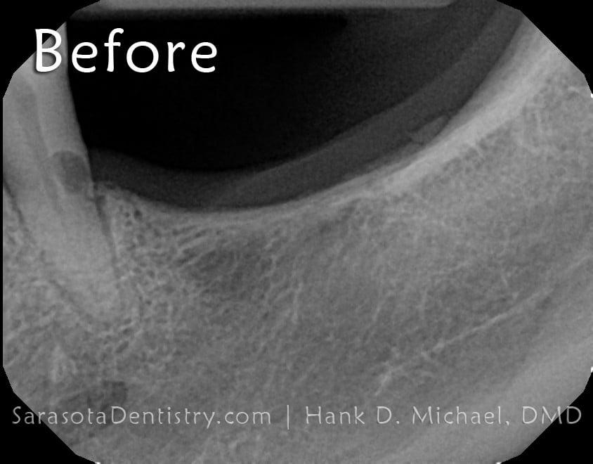 Dental Implants Case: Replacing Missing Back Teeth — view 3
