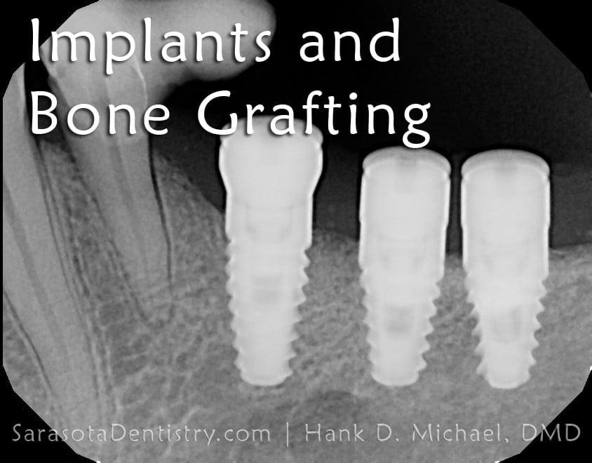 Dental Implants Case: Replacing Missing Back Teeth — view 2
