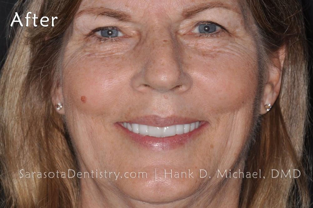 Porcelain Veneers Smile Makeover #13 — view 2
