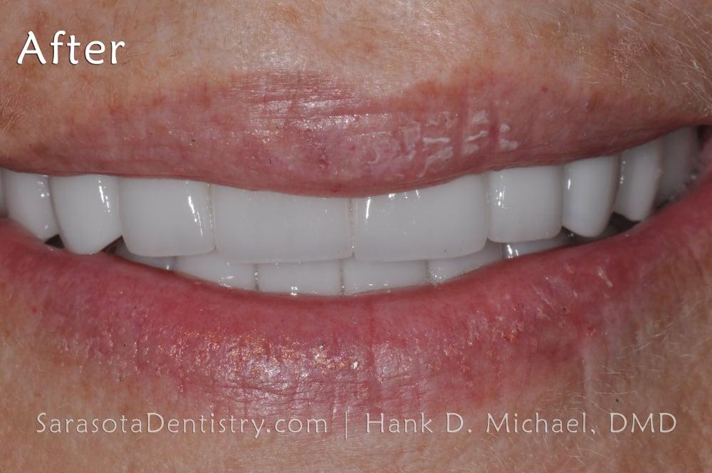 Porcelain Veneers Smile Makeover #13 — view 6