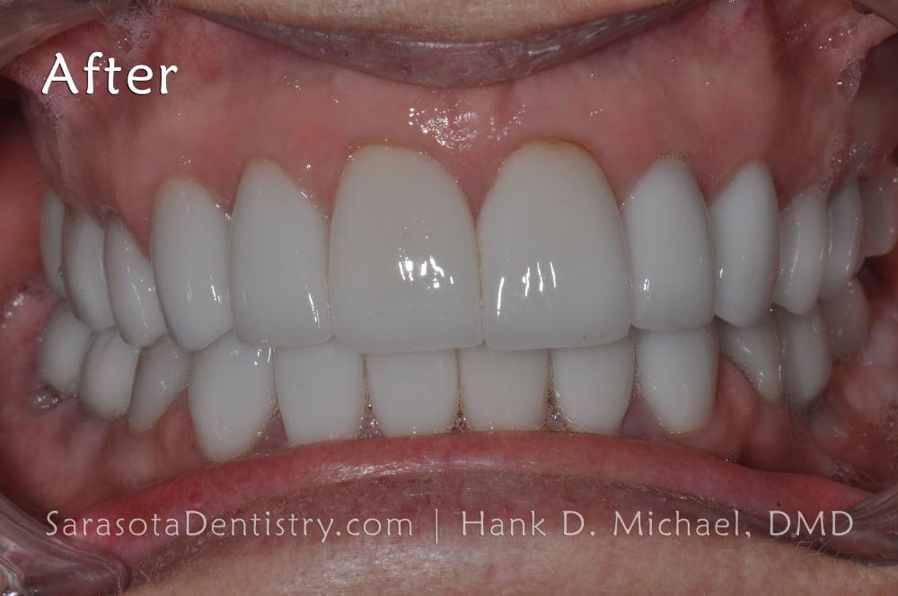 Porcelain Veneers Smile Makeover #13 — view 4