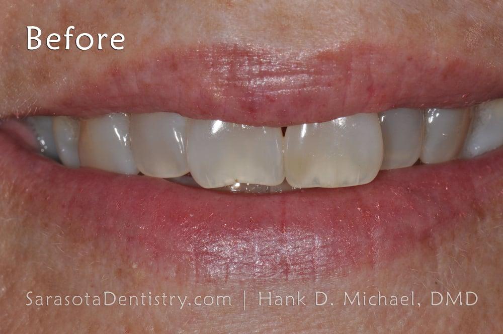 Porcelain Veneers Smile Makeover #13 — view 5