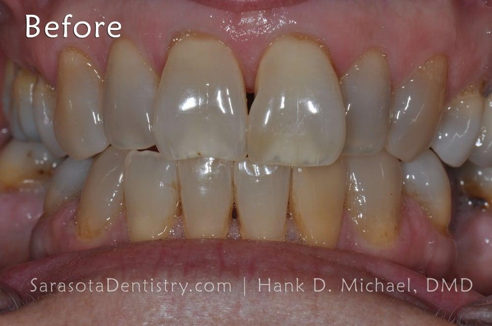 Porcelain Veneers Smile Makeover #13 — view 3