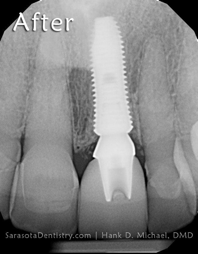 Fractured Tooth Treated with Immediate Dental Implant — view 4