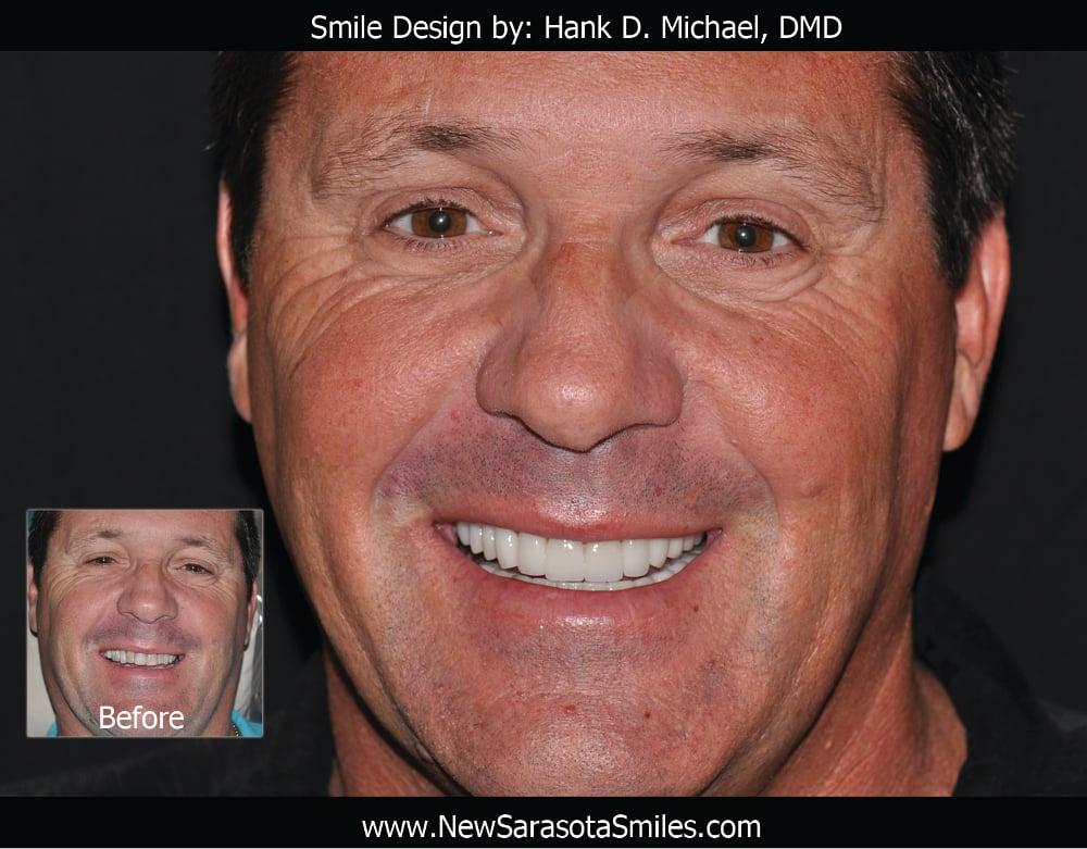 Porcelain Crown Smile Makeover #7 — view 3