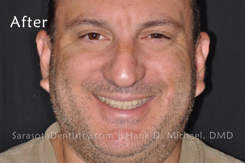 Gap in Front Teeth? Porcelain Crowns are the Solution — view 2