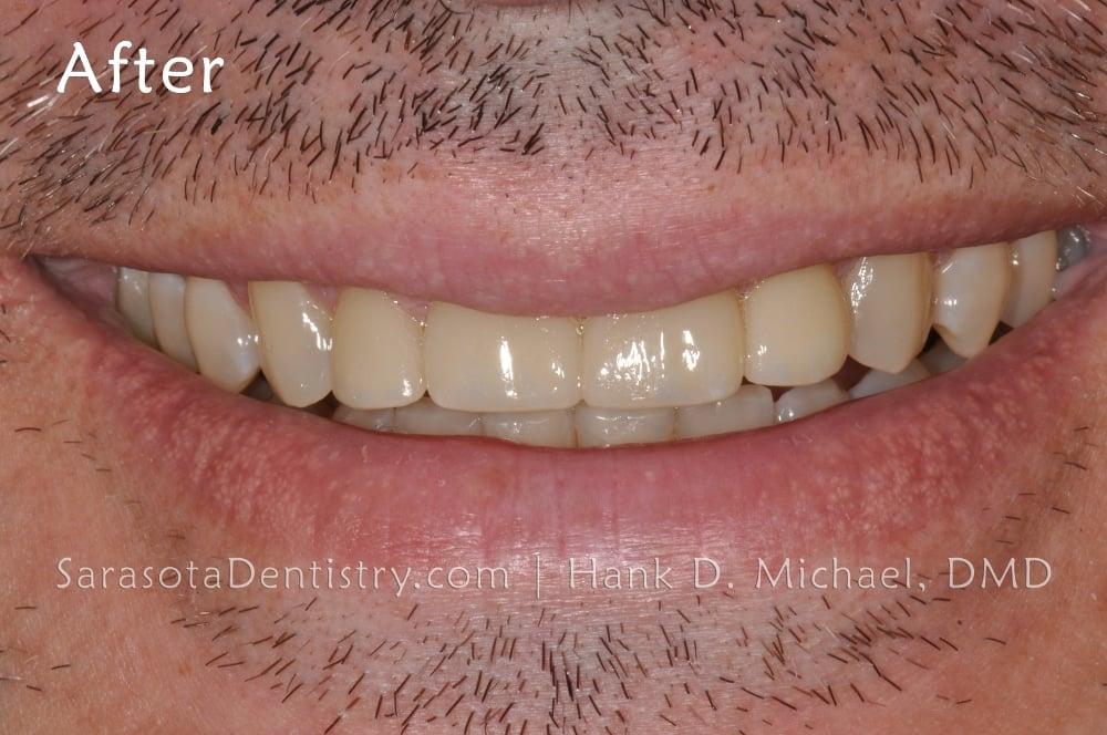 Gap in Front Teeth? Porcelain Crowns are the Solution — view 6