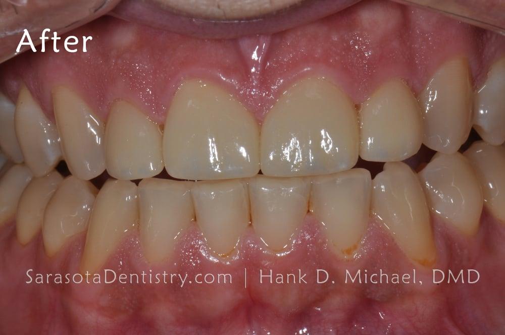 Gap in Front Teeth? Porcelain Crowns are the Solution — view 4