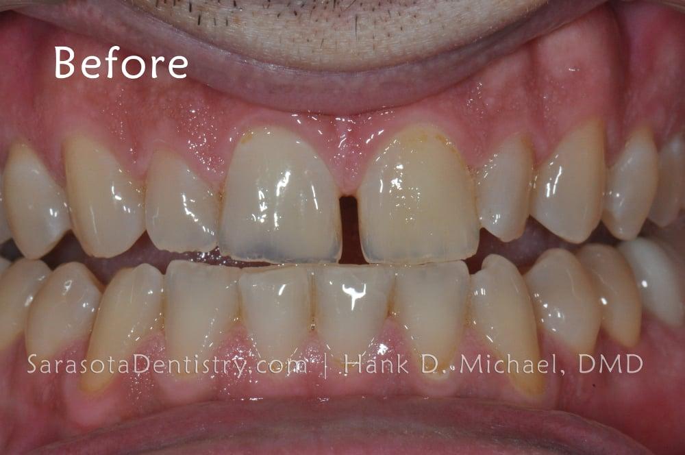 Gap in Front Teeth? Porcelain Crowns are the Solution — view 3