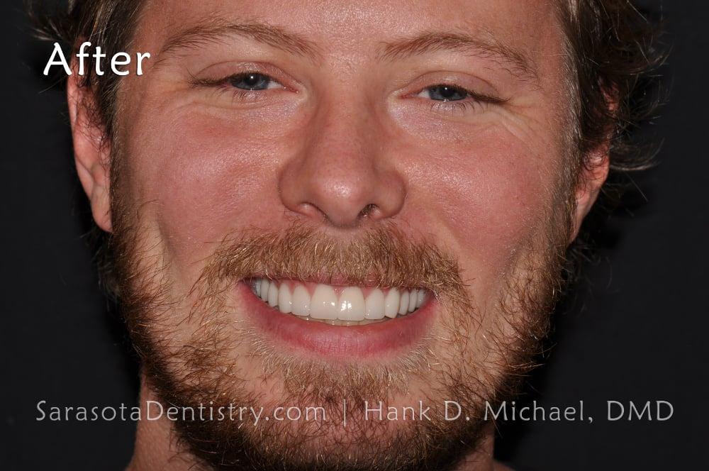 Smile Makeover with Porcelain Crowns & Caps — view 2