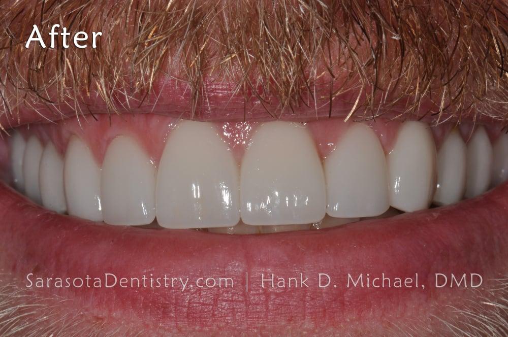 Smile Makeover with Porcelain Crowns & Caps — view 6