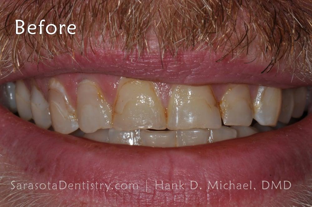 Smile Makeover with Porcelain Crowns & Caps — view 5
