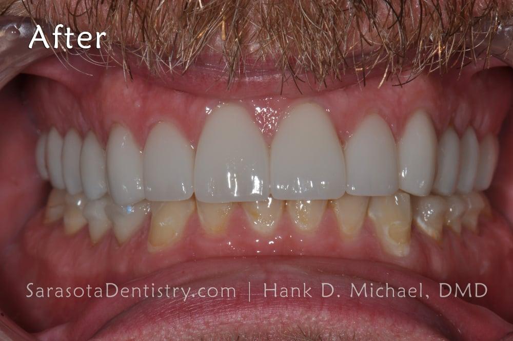 Smile Makeover with Porcelain Crowns & Caps — view 4