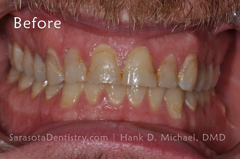 Smile Makeover with Porcelain Crowns & Caps — view 3