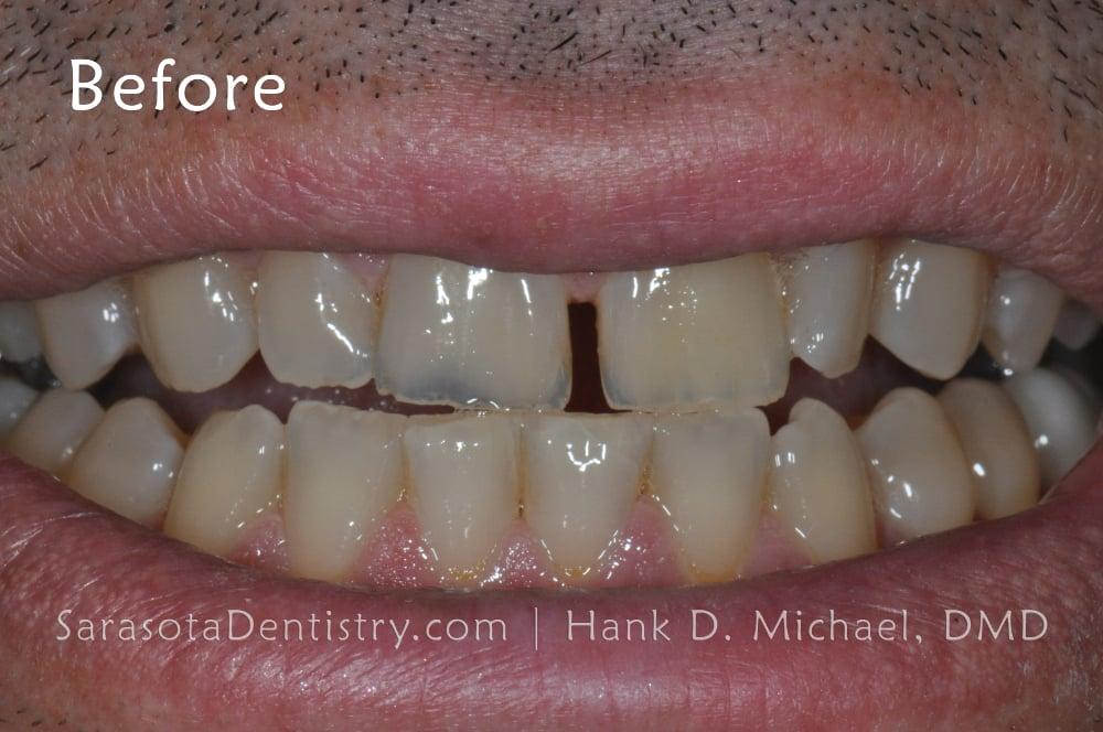 Gap in Front Teeth? Porcelain Crowns are the Solution — view 5