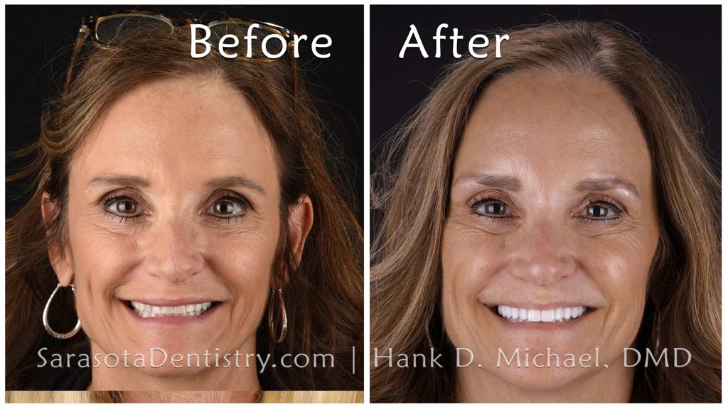 Cosmetic smile makeover — before and after