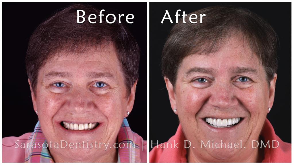 Dental implants and zirconia crowns makeover — before and after